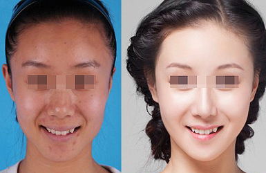 熱拉提的治療效果好不好？多久起效？
